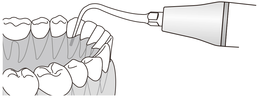 Сфера применения наконечника для скалера